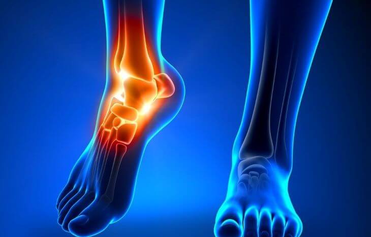 Viêm khớp vùng cổ chân, viêm vao gân trong ống cổ chân là nguyên nhân dẫn đến hội chứng ống cổ chân